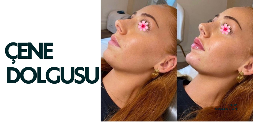 Çene Dolgusu Nedir? Yüzü Bu Kadar Değiştiriyor mu?